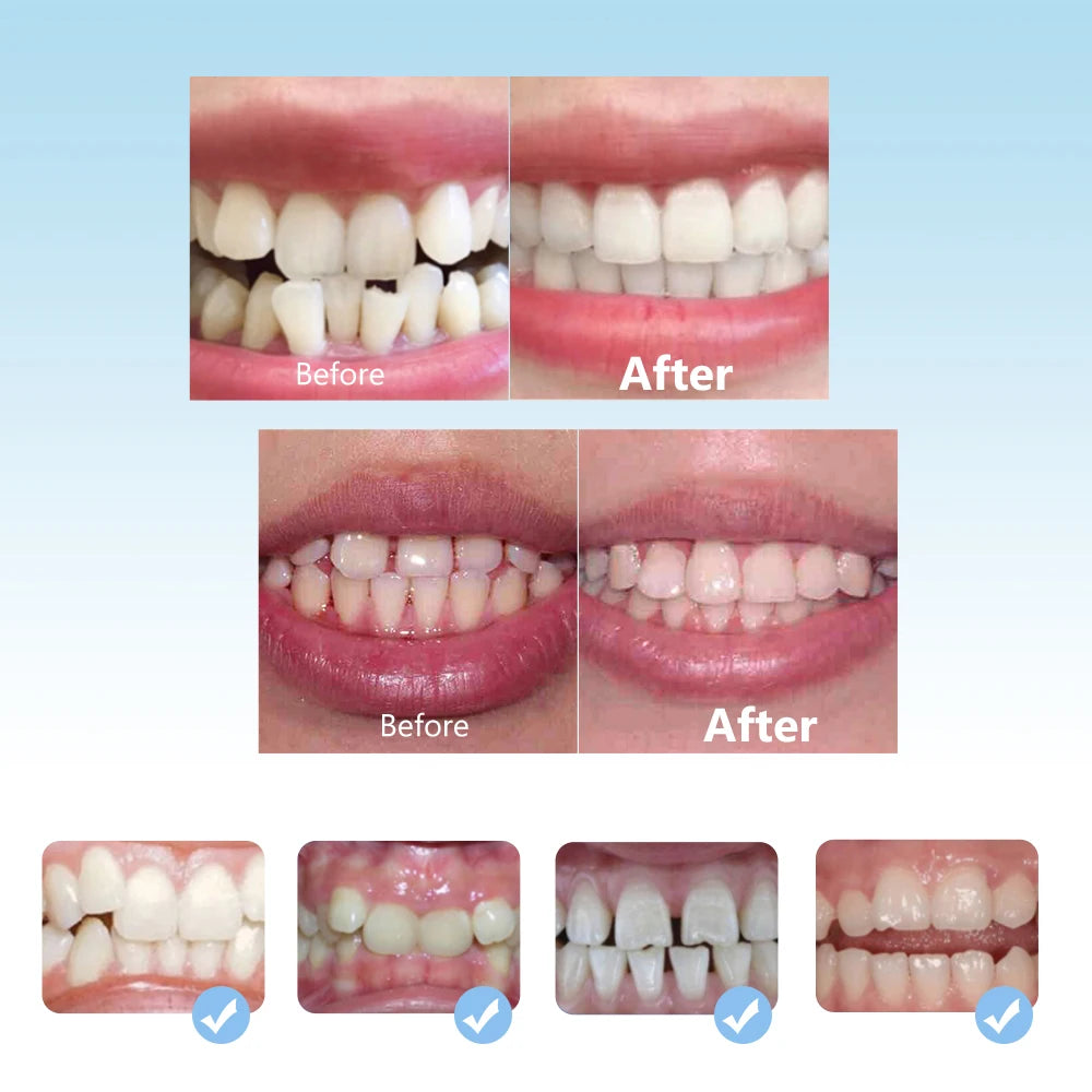 3-Stage Kids Teeth Alignment and Orthodontic Trainer Set