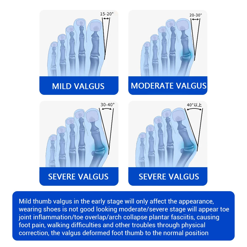 Adjustable Bunion Corrector and Toe Straightener Brace