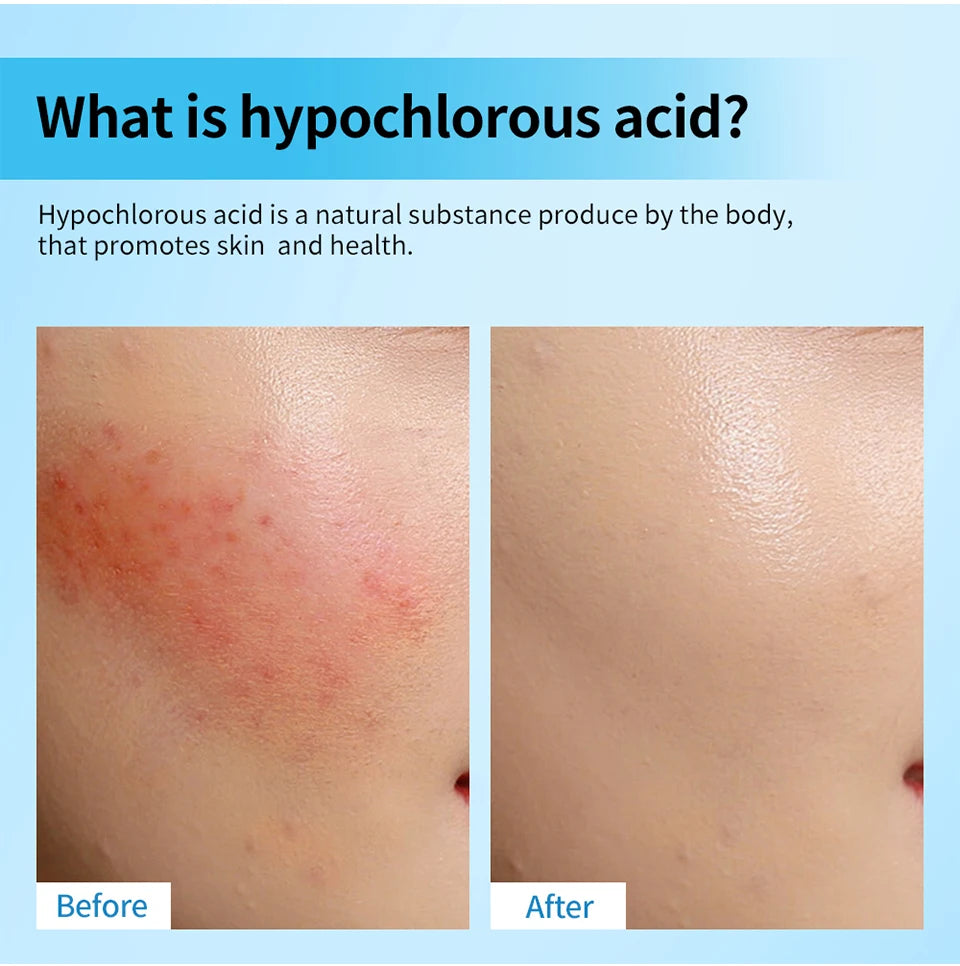 Hypochlorous Acid Soothing Facial Spray for Acne and Sensitive Skin