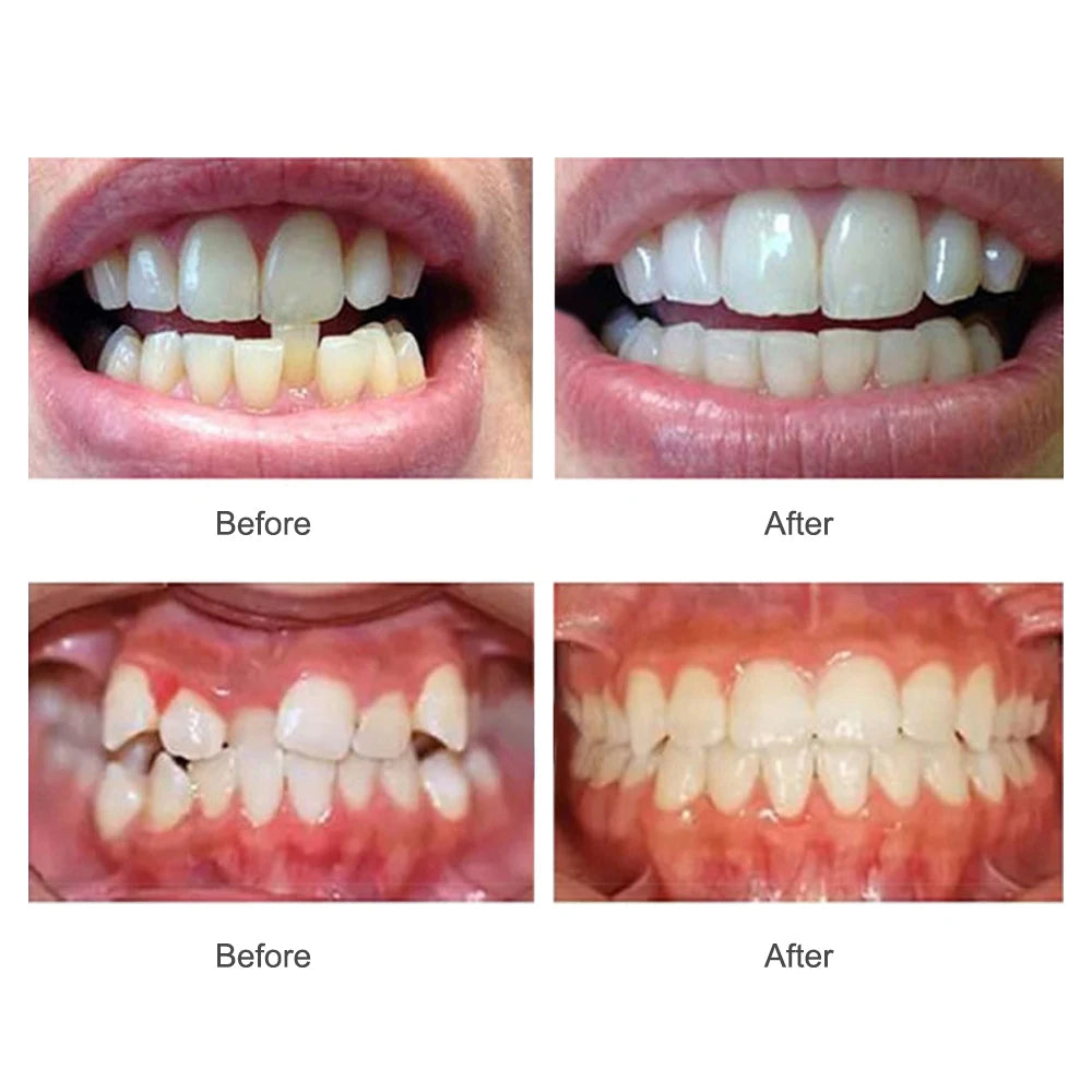 3-Stage Teeth Straightening Alignment Trainer for Adults